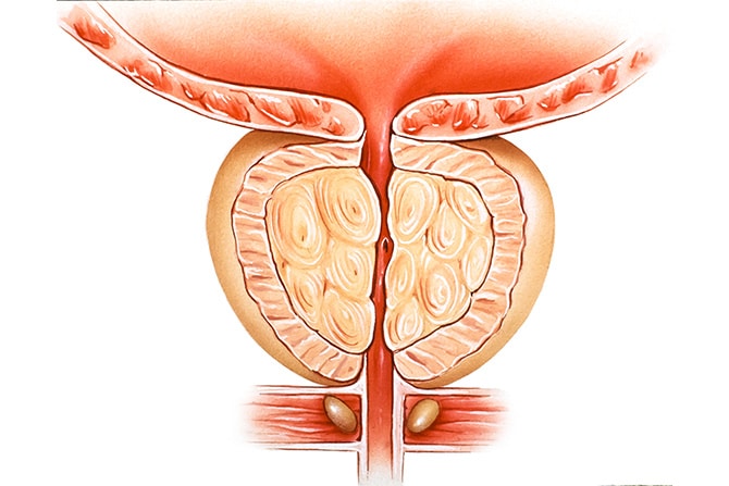 Benign Prostatic Hyperplasia