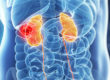 Kidney cancer