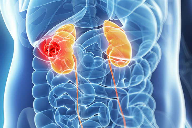 Kidney cancer