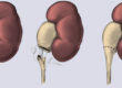 Ureteropelvic Junction Obstruction