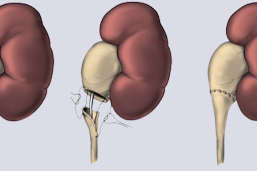 Ureteropelvic Junction Obstruction