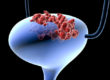 Bladder cancer